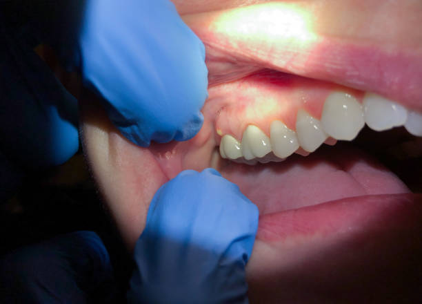 Best Dentist for Tooth Abscess  in Somers Point, NJ